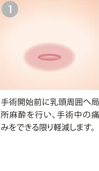 乳頭周囲への居所麻酔