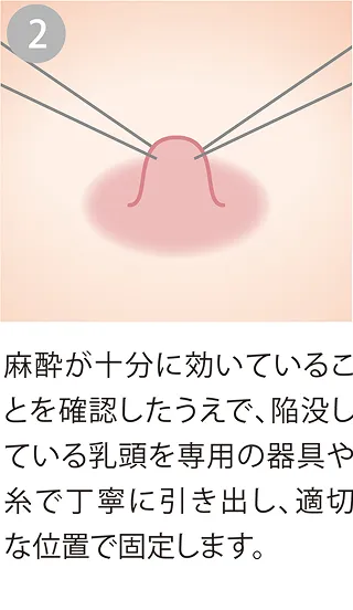 乳頭を引き出し固定