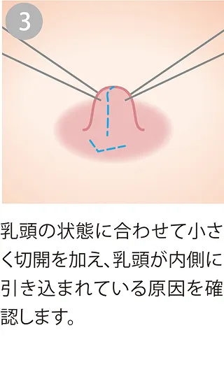 乳頭を小さく切開
