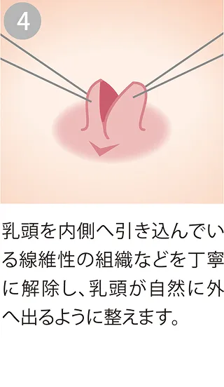 線維性の組織などを解除