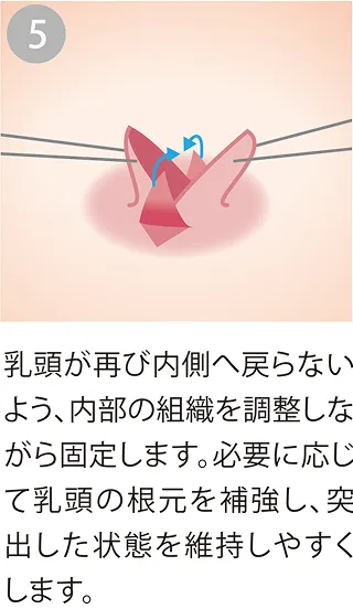 乳頭の内部の組織を固定