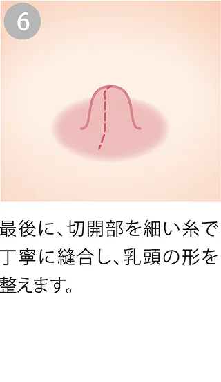 縫合し乳頭の形を整える